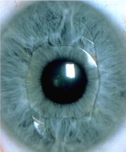 1998 - Eerste implantatie Myopia Claw Lens