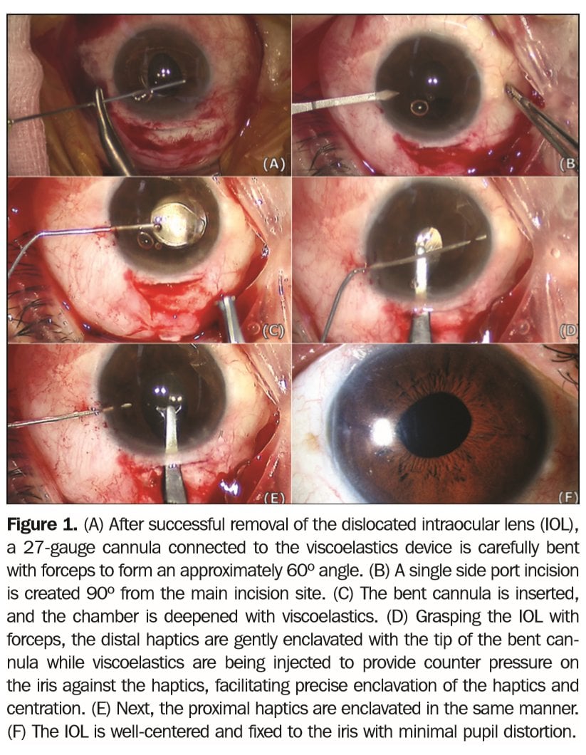 (source: J. Refract Surg. 2018 Aug 1:34|(8): 564-566)